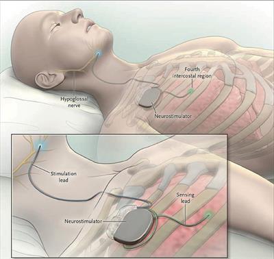 Development of a Clinical Pathway and Technical Aspects of Upper Airway Stimulation Therapy for Obstructive Sleep Apnea